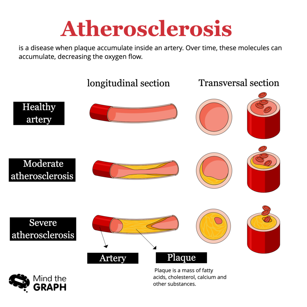 aterosklerosis